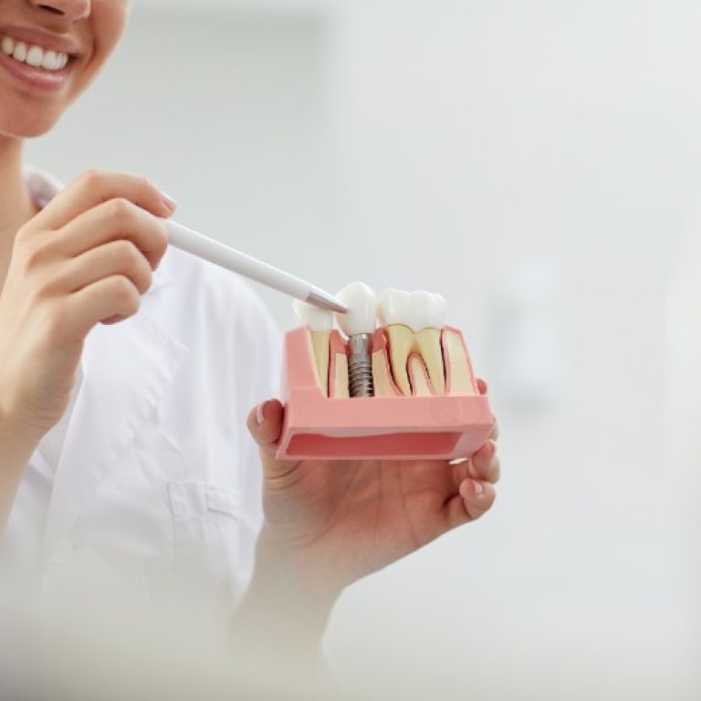 רופאת שיניים מסבירה על השתלת שיניים