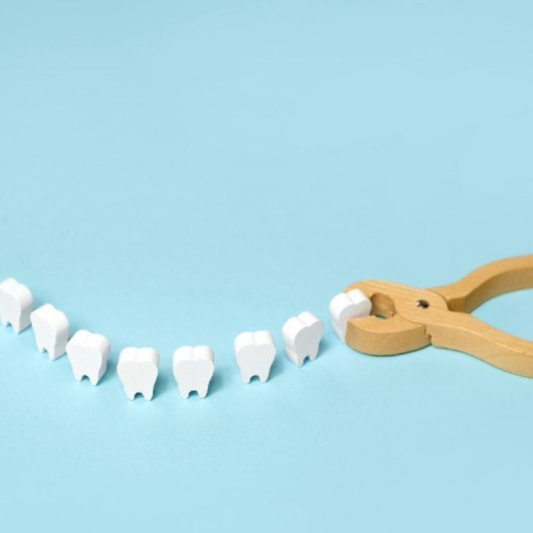 עקירת שיניים כלואות